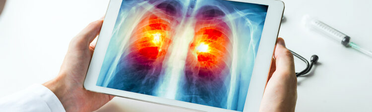 Casi cinco millones de personas más en Estados Unidos ahora serán elegibles para hacerse pruebas de detección de cáncer de pulmón.
 (Dreamstime)