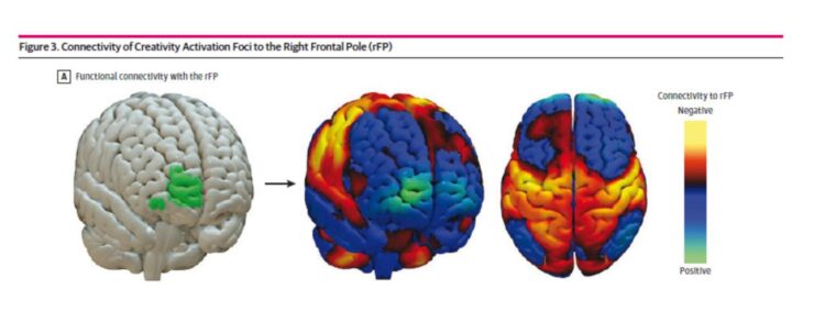 La conectividad funcional (verde, izquierda) define un circuito cerebral distribuido (derecha) que abarcará coordenadas activadas por tareas de creatividad. EFE/Crédito: Hospital Brigham and Women's